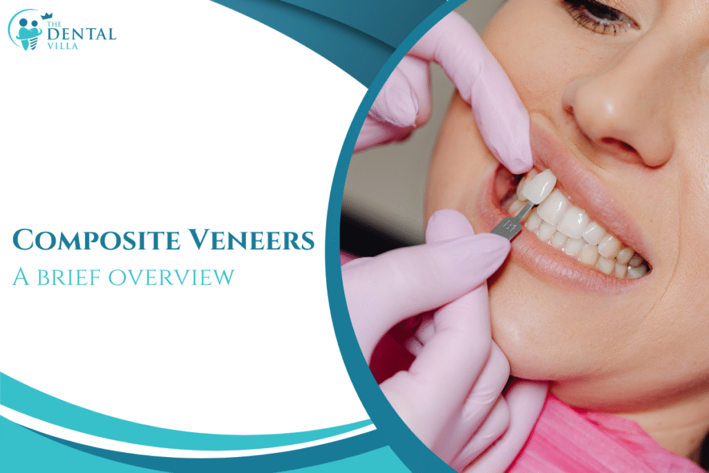 Composite Veneers